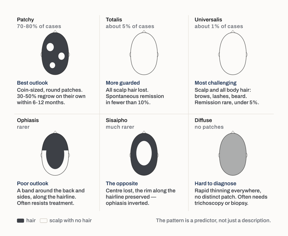 The six patterns of alopecia areata.