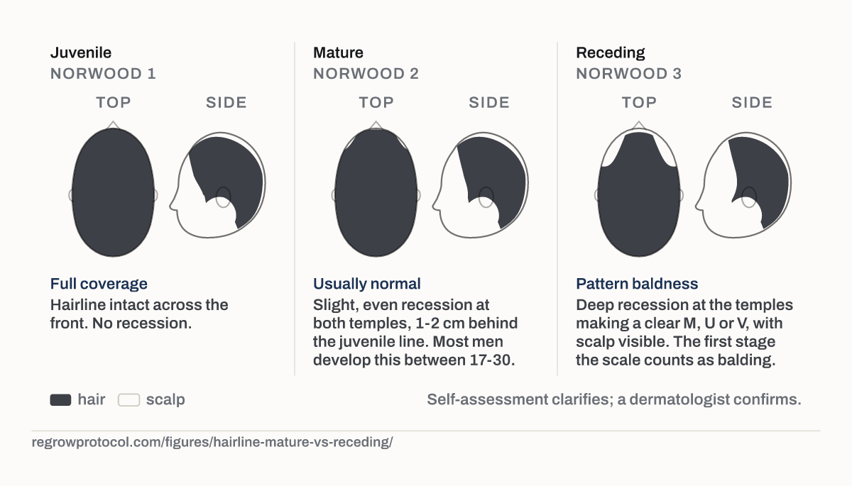 Mature hairline or receding hairline.