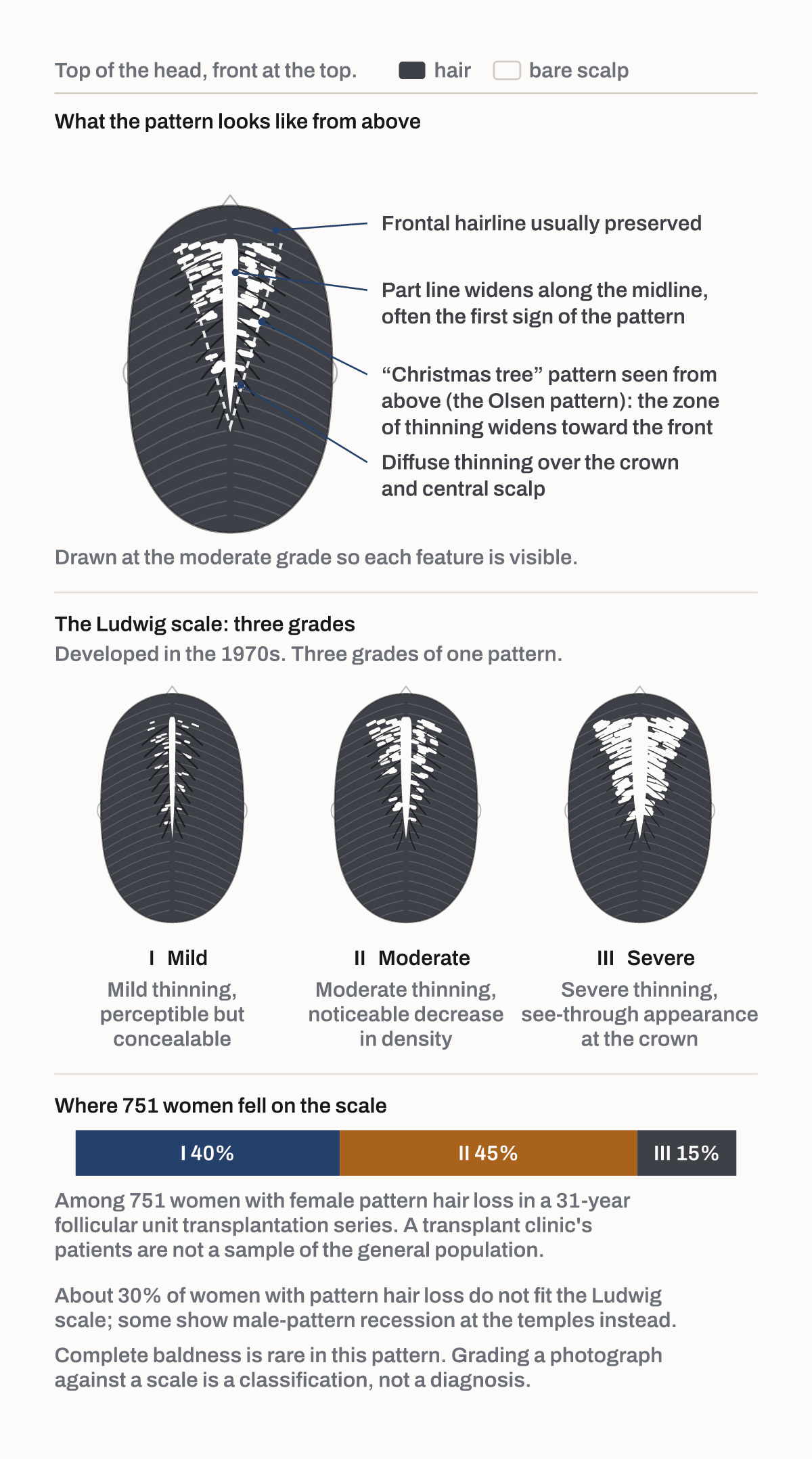 The Ludwig scale, grades I to III. Female pattern hair loss seen from above.