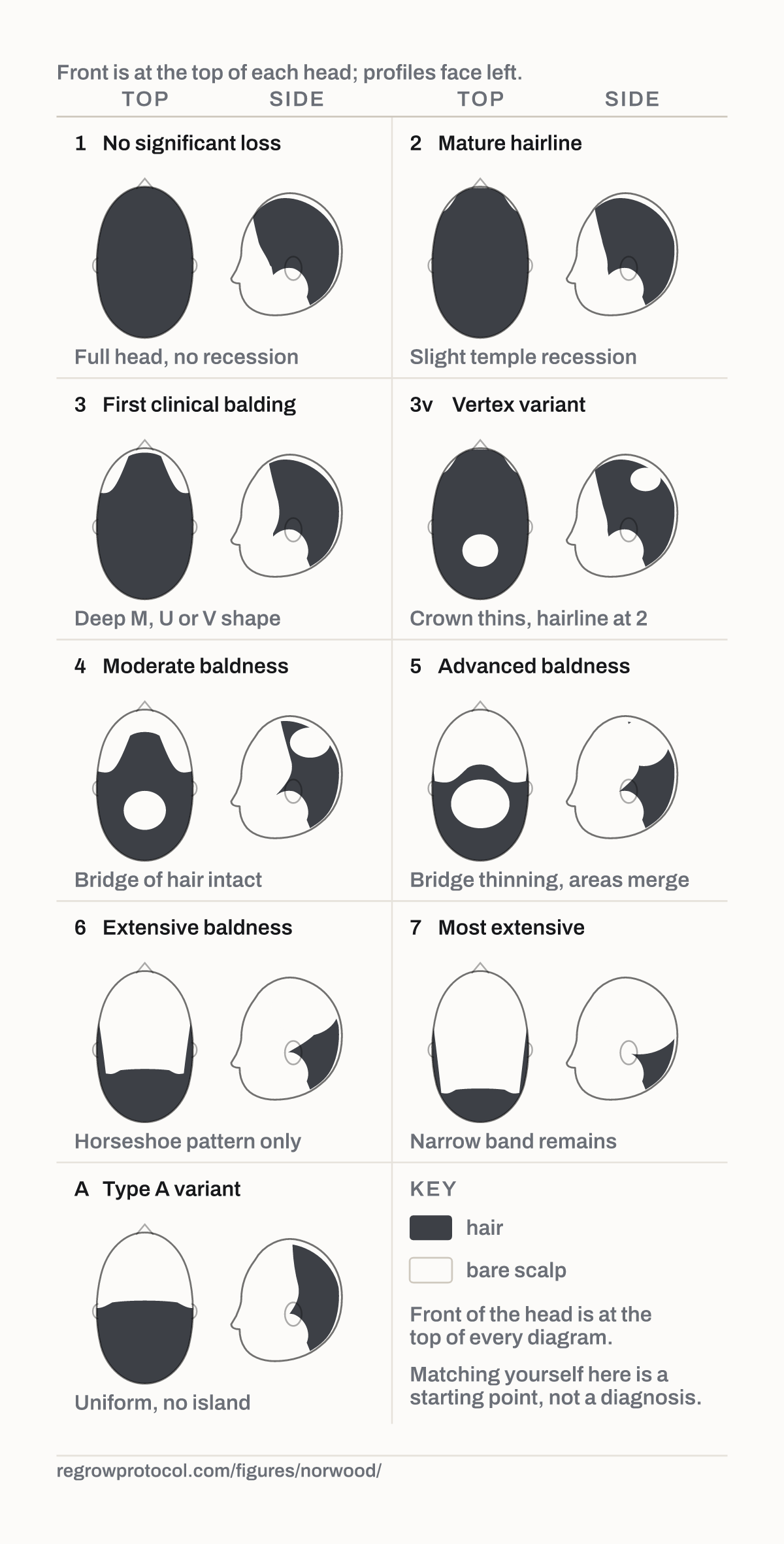 The Norwood scale, stages 1 to 7 and the Type A variant. Each stage is drawn twice: the top of the head with the front at the top, and the profile facing left.